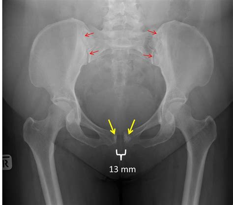 Symphysis Pubis Diastasis Radiology Cases