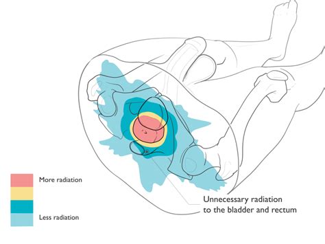 Prostate Cancer Radiation Treatment Emory Proton Therapy Center
