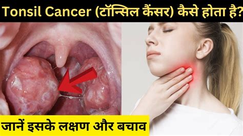Tonsil Cancer Symptoms In Hindi टॉन्सिल कैंसर कैसे होता है जानें