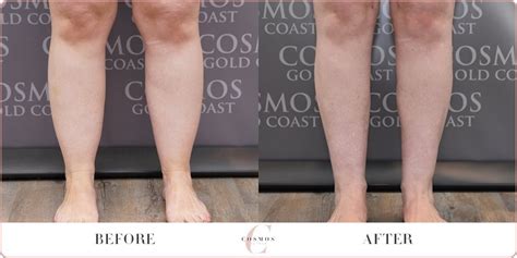 Calf Contouring Before And After Cosmos Aesthetics
