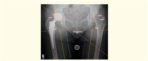 Measurement Of Acetabular Cup Inclination Anteversion And Leg Length