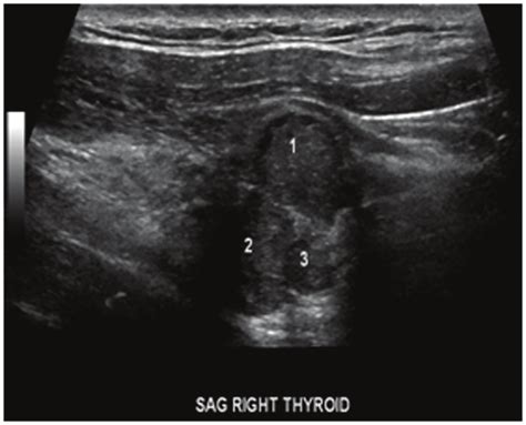 Ultrasound Showing Parathyroid Mass In Relation To The Two Thyroid