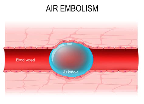 Air Embolisms And The Sensors To Combat Them Smd Sensors
