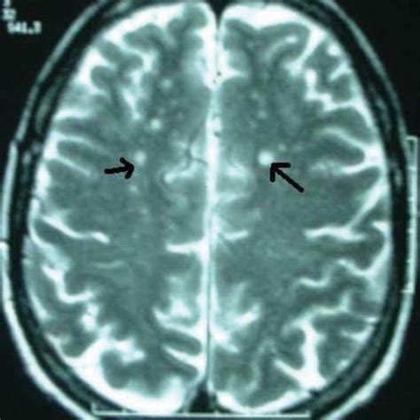 White Matter Lesions On T2 Weighted Mri Scanning Case 1 Download