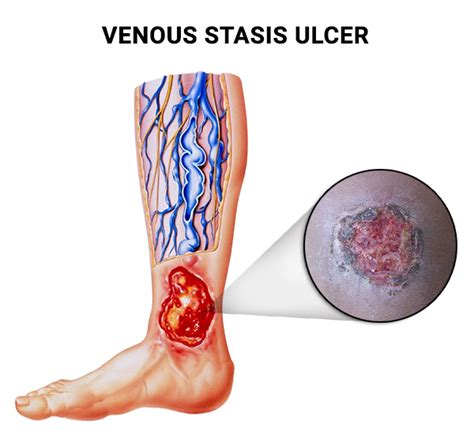 Ulcer Treatment Specialists In Nyc Nj Vein Care Center