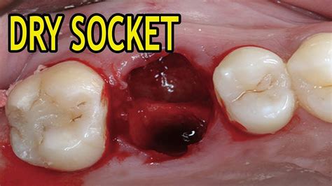 Dry Socket Causes Signs Symptoms Prevention And Treatment