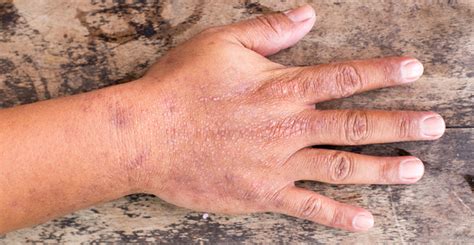 Dermatitis On Top Of Hands