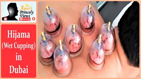 Wet Cupping Therapy Hijama Benefits st Time Experience in Dubai العلاج بالحجامة الرطبة