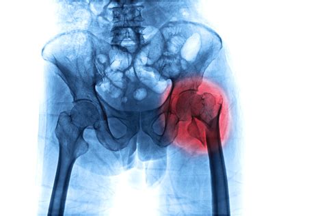 Why Hip Fractures Are Especially Damaging To The Elderly