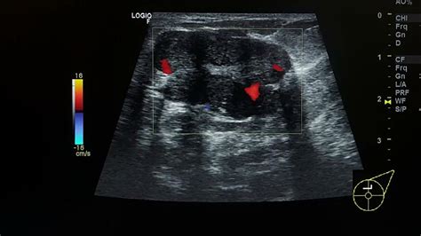 Fibroadenoma Ultrasound Case Youtube