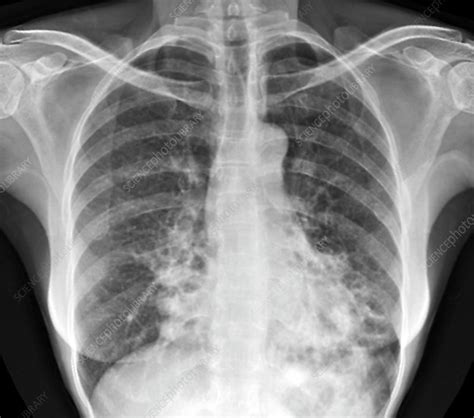 Bronchiectasis X Ray Stock Image C0371494 Science