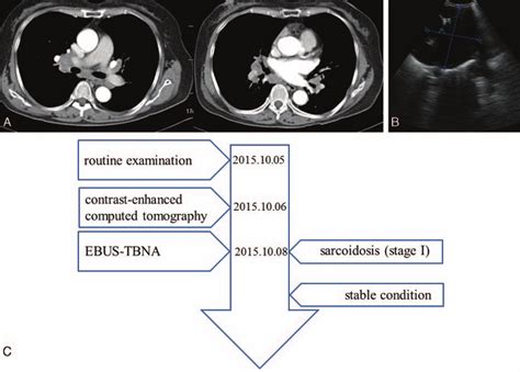 A Cect Image Showing Enlarged Bilateral Hilar Lymphadenopathy B Ebus