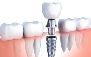 Dental Implants Rochester Replace Missing Teeth Cost Of Dental Implants