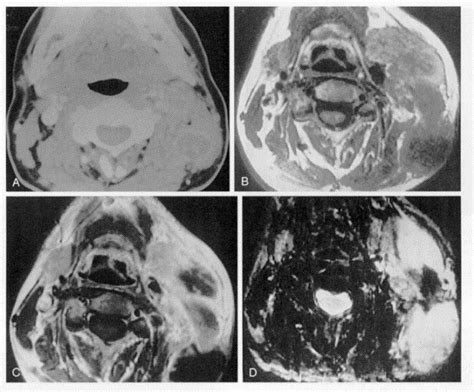 Ct And Mr Imaging Evaluation Of Neck Infections With Clinical