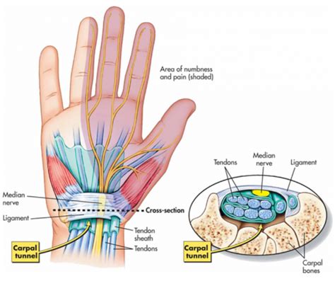 Carpal Tunnel Syndrome Active Health