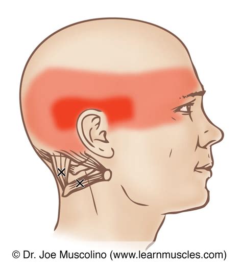 Suboccipital Group Trigger Points Learn Muscles
