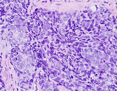 Pathology Outlines Sebaceous Carcinoma