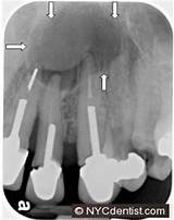 Images of Root Canal Emergency Room