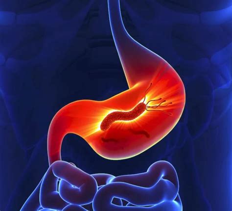 Gastritis síntomas causas tratamiento y dieta a seguir