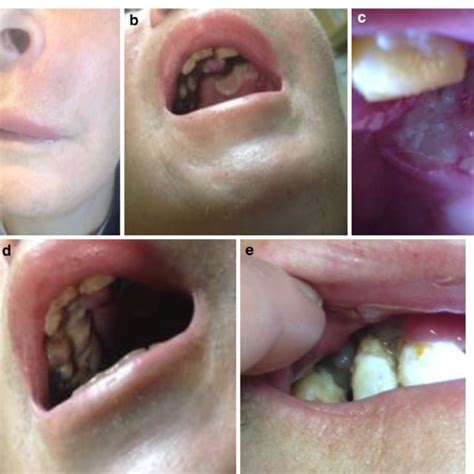 A Left Sided Facial Swelling Causing Lip Droop And Associated Drooling