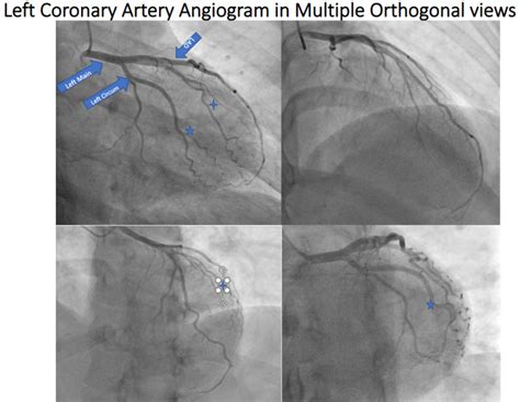 Figure Left Coronary Angiogram In Various Statpearls Ncbi