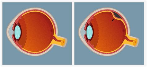What Is Retinal Detachment And How To Treat It