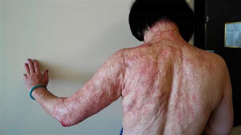 Vietnam Wars ‘napalm Girl Has Laser Treatment For Wounds The Irish