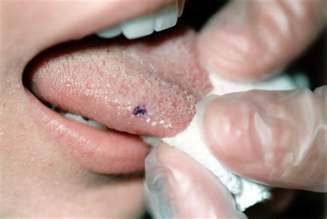 The post explores on causes and possible ways on how to get rid of get more insights on the causes of black, white, brown or painful spots on the tongue. Tongue biopsy. Causes, symptoms, treatment Tongue biopsy