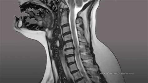 3d Precision Diagnostics Cervical Spine Injuries Mri Youtube