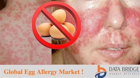 Pin On Global Egg Allergy Research Report