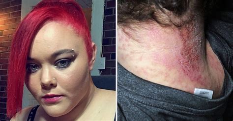 Mum Who Was Left Swollen Scabbed And Scarred By Hair Dye Urges People