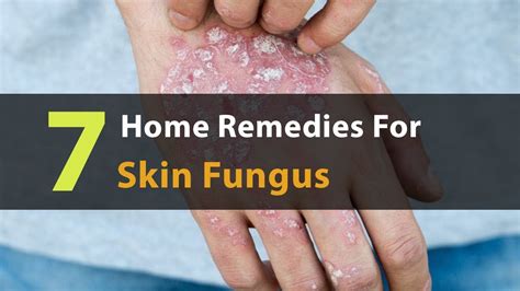 7 Home Remedies For Skin Fungus That Actually Work Dr Laelia Youtube
