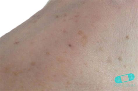 Liver Spots On Arms And Legs