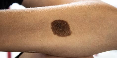 What Is Melanocytic Nevus And How To Treat It