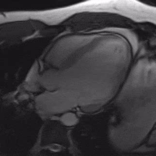 Common symptoms include headache, loss of smell and taste, nasal congestion and rhinorrhea, cough. Prior Myocarditis in Setting of COVID-19 Infection ...
