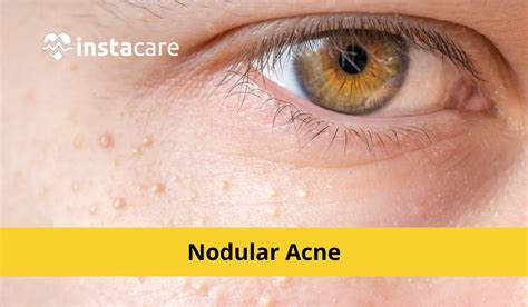 Nodular Acne Causes Symptoms Treatment And More
