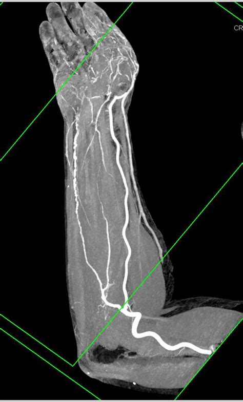 Beading Of The Ulnar Artery Best Seen On Bone Removal Musculoskeletal