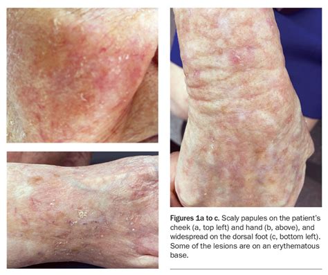 Recurrent Scaly Papules On Sun Exposed Skin Medicine Today