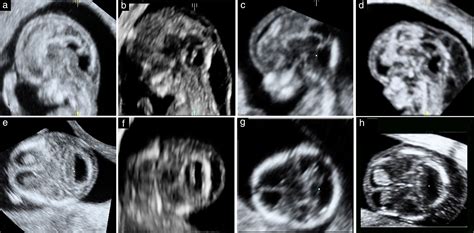 Non‐visualization Of Choroid Plexus Of Fourth Ventricle As First