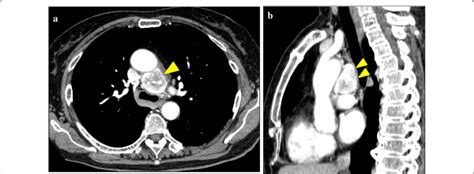 Chest Ct Scan Preoperative Contrast Enhanced Chest Computed Tomography