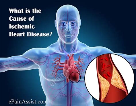 Ischemic Heart Diseasecausessignssymptomsdiagnosis
