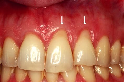 Stadsklev Dental Blog What Is Gum Recession And Why Is It A Concern