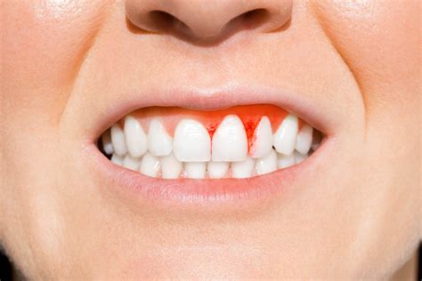 How To Treat Gingivitis Coral Dental Care