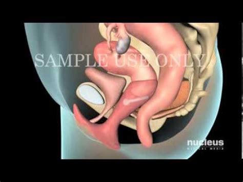 Pessary Insertion Video Animation Video Pessary Insertion Video Youtube
