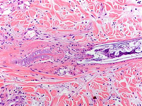 Effects Of Loxoscelism On Skin Coagulation Necrosis Affecting The