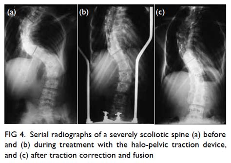 Halo Pelvic Traction A Means Of Correcting Severe Spinal Deformities