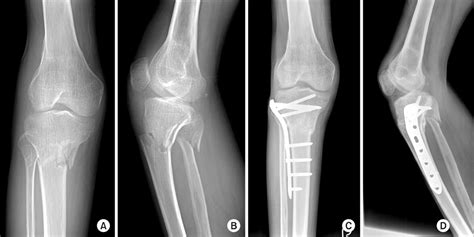 Treatment Of Proximal Tibia Fractures Using Lcp By Mipo Technique