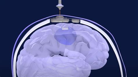 New Ultrasound Device Helps Powerful Chemo Reach Deadly Brain Cancers