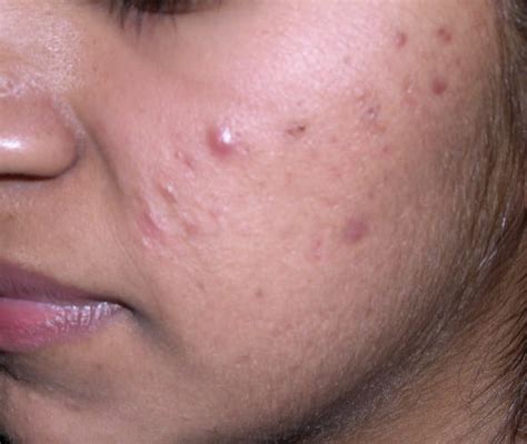Acne And Rosacea A Closer Look At Skin Of Color