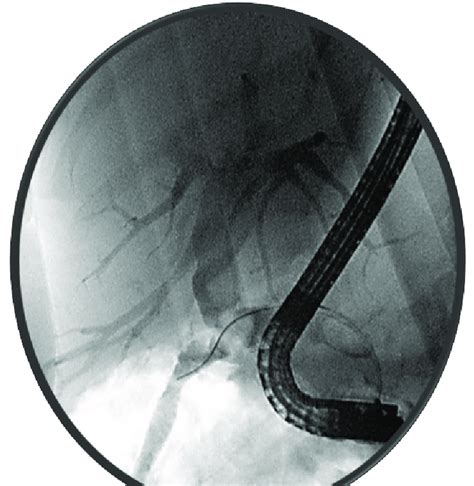 Ercp Imaging Demonstrates A Large Fistula Between The Gallbladder And